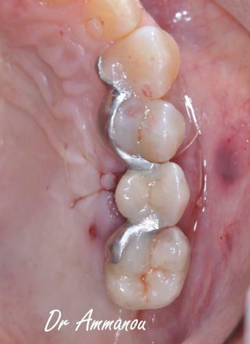 L'extraction dentaire – préservation osseuse avant la mise en place d'un  implant dentaire Le Perreux sur Marne (94170)