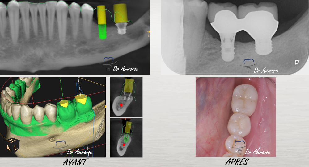 les implants courts expliqué chez votre dentiste au perreux