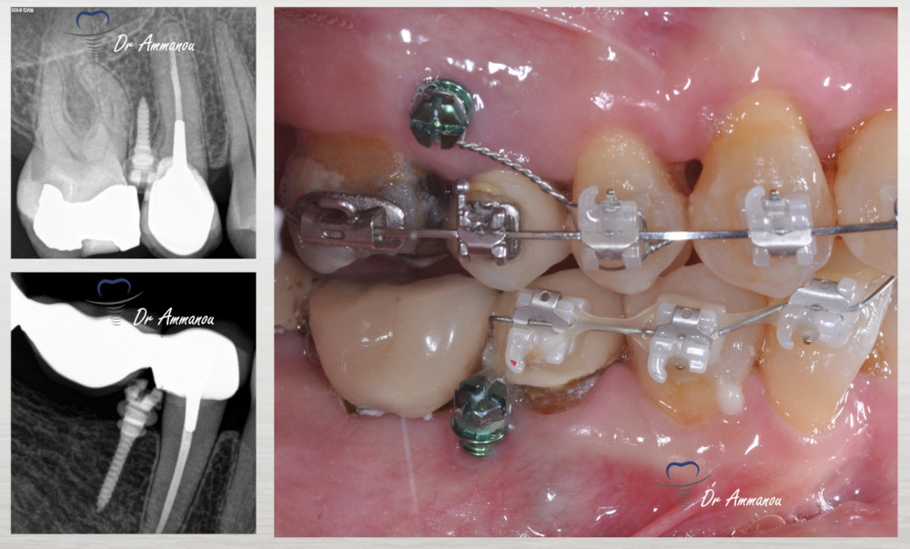 Les Mini vis orthodontiques chez l'adulte Le Perreux sur Marne (94170)   Cabinet d'Implantologie et de Parodontologie du Dr Terence Ammanou Dentiste  au Perreux sur Marne